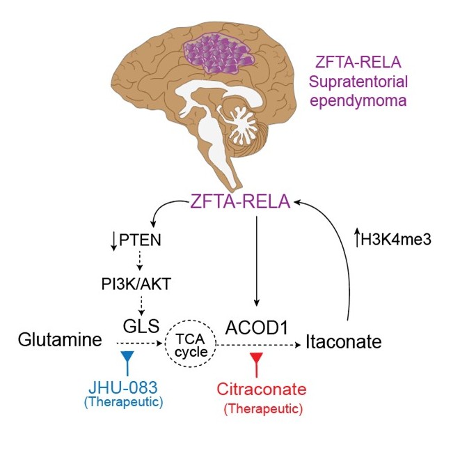 An illustration of the ZFTA-RELA pathways that produce high levels of Itaconate, which feed the ZFTA-RELA Supratentorial ependymoma.